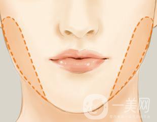 去頰脂墊多久恢復(fù) 與哪些因素有關(guān)？