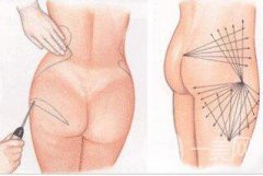 廣東臀部抽脂大概多少錢 廣東臀部抽脂價格