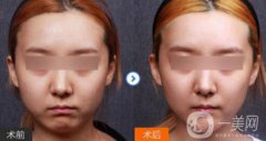 下巴做膨體還是硅膠好 果怎么樣呢