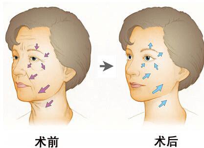 伊維蘭除皺要多少錢 價(jià)格是多少