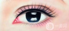 眼瞼下至多久后會回縮 眼瞼下至術(shù)后護理