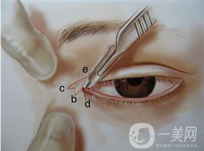 韓式開眼角價格 韓式開眼角多少錢