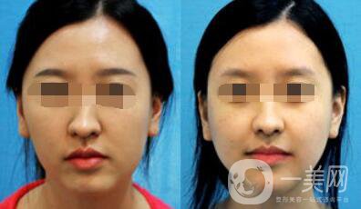 歪鼻矯正的危害 歪鼻矯正術后護理詳細介紹