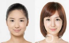 頰脂墊去除后還會(huì)長(zhǎng)嗎 去頰脂墊果保持多久