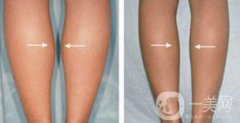 注射瘦臉注射瘦腿多少錢 注射瘦臉注射瘦腿具體價(jià)格介紹