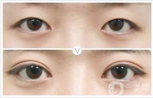 割雙眼皮和埋線哪個*果比較好？