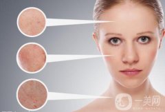 激光嫩膚價(jià)位 收費(fèi)情況介紹