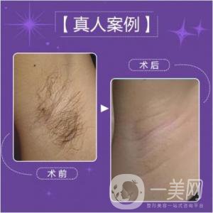 激光脫毛多少錢一次比較合理？