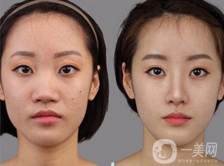 北京*整形多少錢 和哪些因素有關(guān)？