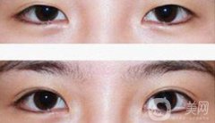 八月割雙眼皮會(huì)發(fā)炎嗎 雙眼皮術(shù)后護(hù)理事項(xiàng)介紹