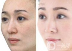 嫩膚多少錢 醫(yī)療美容嫩膚價格詳解