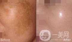 如何去除妊娠斑 去妊娠斑多少錢