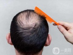 fut植發(fā)技術怎么樣 fut植發(fā)技術好不好