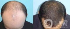 fue植發(fā)果 頭發(fā)種植果怎么樣