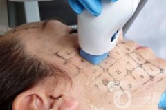 塑美極果怎么樣 塑美極能除皺嗎