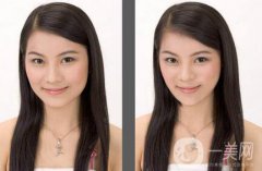 下頜角截骨手術會復發(fā)嗎？