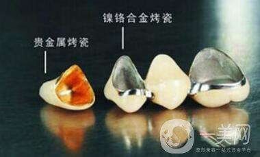 上海鈷鉻烤瓷牙價(jià)格 鈷鉻烤瓷牙要多少錢(qián)