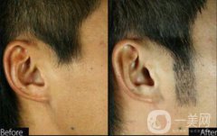 植鬢角大概多少錢 鬢角種植價格詳解