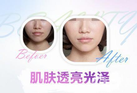 果酸換膚的功* 有哪些好處？