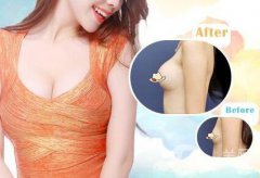 隆胸術后的后遺癥有哪些 隆胸有哪些風險