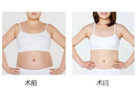 360度環(huán)形吸脂有哪些術(shù)后注意事項(xiàng)？