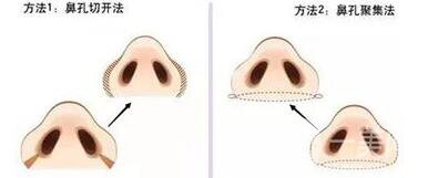蒜頭鼻整形要多少錢 蒜頭鼻整形價格