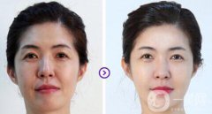 飛頓彩光嫩膚果如何 飛頓彩光嫩膚前后圖