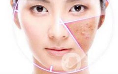 做果酸換膚多少錢(qián)一次 果酸換膚具體價(jià)格