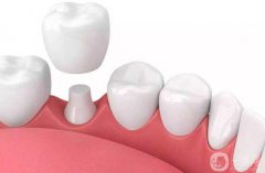 貴金屬烤瓷牙多少錢(qián)一顆 貴金屬烤瓷牙一顆的價(jià)格