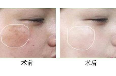 *風(fēng)范祛斑多少錢一次 與哪些因素有關(guān)？