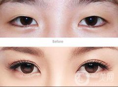 哪里割雙眼皮好 割雙眼皮醫(yī)院介紹