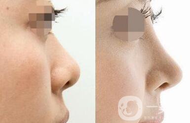 *術(shù)后注意事項 *整形術(shù)后如何護理