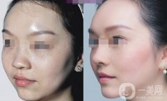 鼻部手術(shù)恢復(fù)期注意事項(xiàng) 鼻部手術(shù)術(shù)后護(hù)理