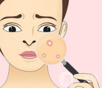 快速*去痘印的方法有哪些？