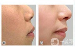 光子嫩膚前后*果嗎 果怎么樣？