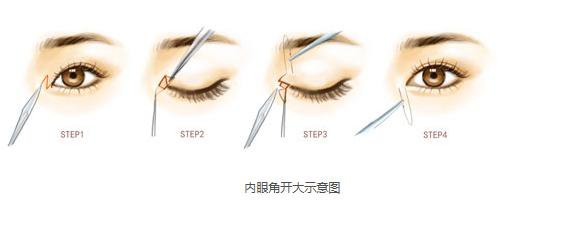 做開內(nèi)外眼角手術(shù)需要多少錢？