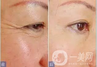 *去魚尾紋*嗎 *果怎么樣？