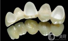 做美容冠矯正齙牙多少錢？