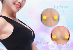 雙平面假體豐胸怎么樣 雙平面假體豐胸好不好