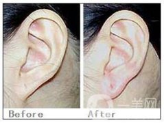 注射玻尿酸豐耳垂好嗎 玻尿酸填充耳垂怎么樣