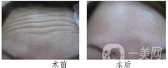 抬頭紋太深怎么去掉 去抬頭紋果照片