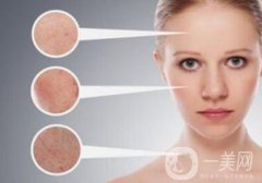 激光祛斑會反彈嗎 要注意些什么