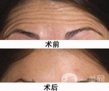 抬頭紋重怎么辦 快速去除抬頭紋的方法