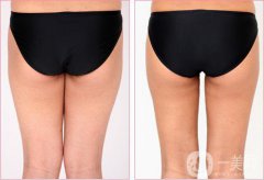 上臀吸脂減肥術(shù)價(jià)格一般是多少錢？