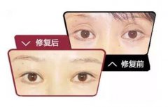 眼窩凹陷手術介紹 什么是眼窩凹陷手術