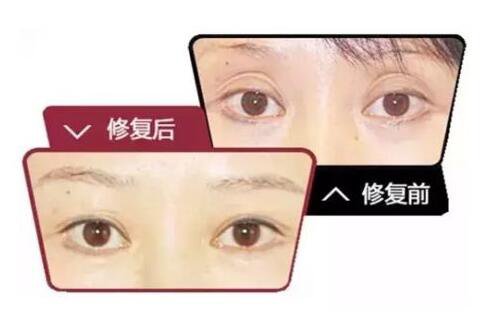 眼窩凹陷手術(shù)