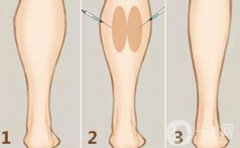 注射瘦臉注射瘦腿的價(jià)格 注射瘦臉注射瘦腿費(fèi)用介紹