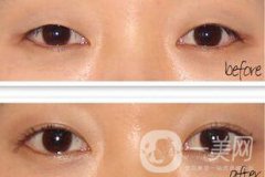 手術(shù)開(kāi)眼角要多少錢 開(kāi)眼角的費(fèi)用