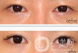手術(shù)開(kāi)眼角要多少錢 開(kāi)眼角的費(fèi)用