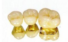 金鈀合金烤瓷牙優(yōu)缺點詳細介紹